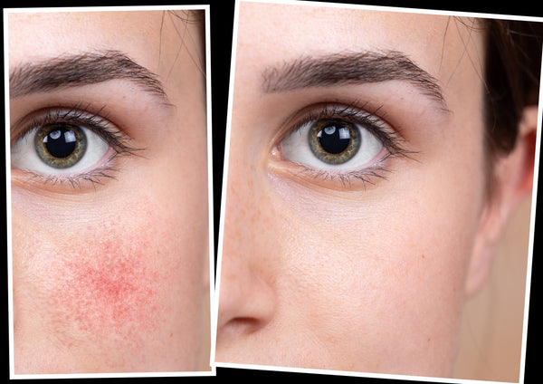 Best rosacea online skin care regimen